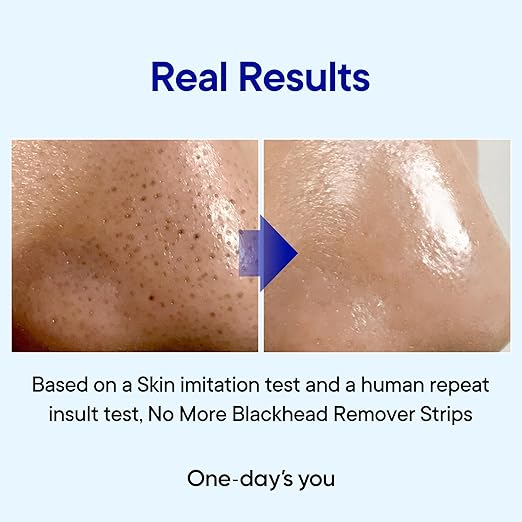 One day's you P.Z SSOC SSOC NO MORE BLACK HEAD Special Set